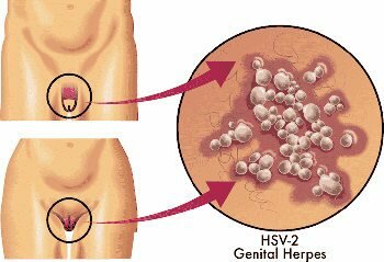 Aciclovir (creme ou comprimidos) também trata herpes genital em homens e mulheres